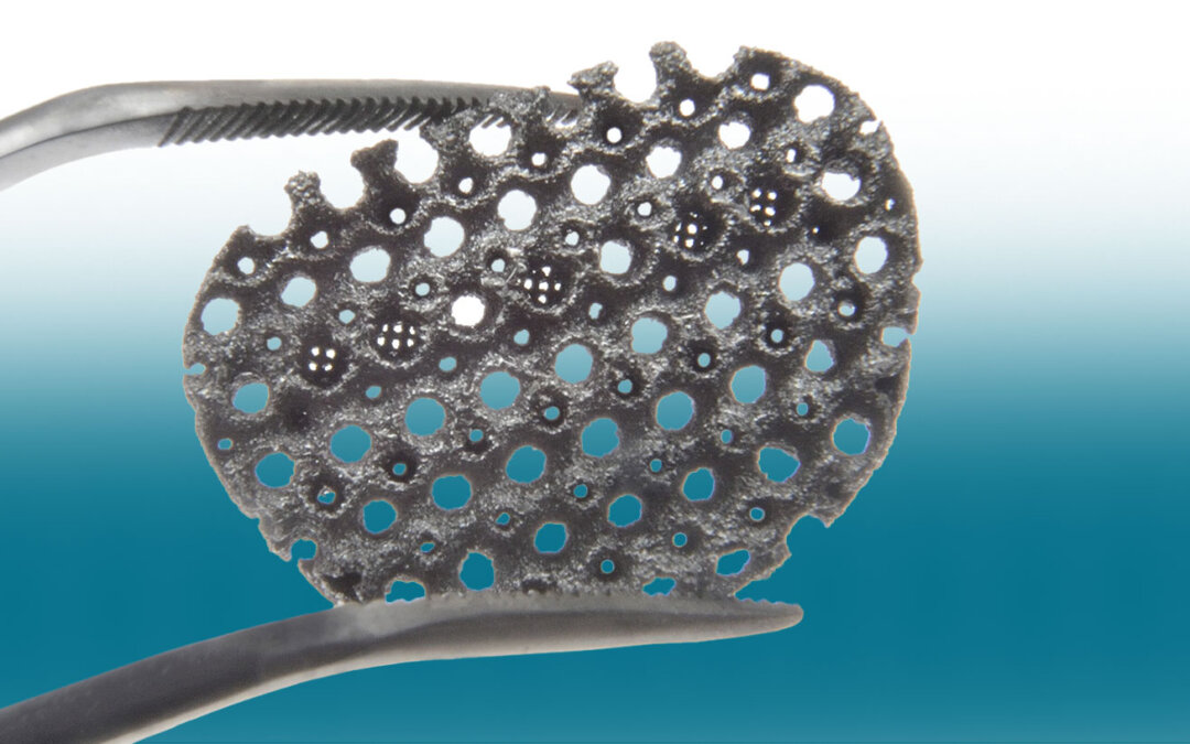 Tantalum Parts for Orthopedic Applications – A Brief Review